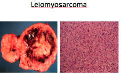 Post menopausal women. Single lesion with areas of necrosis and hemorrhage.