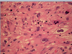 Smooth muscle tumors of uncertain malignant potential (STUMP)