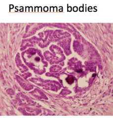 Well-defined papillary structures and many psammoma bodies
Low grade cytologic atypia
Probably arise via borderline tumors
Better prognosis