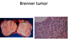 BRENNER TUMOR. Most are benign; rare borderline and malignant variants