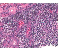 chronic inflammation with germinal centers and hurtle cells (eosinophilic metaplasia of cells that line follicles). Increased risk for B cell non hdg lymphoma and it presents as an enlarging thyroid late in the course of disease