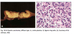 Age – 48 yrs, M:F = 1:1. signet ring cells that diffusely infiltrate the gastric wall-thickening of the stomach walls due to desmoplasia. Diffuse type not associated to intestinal type risks.
