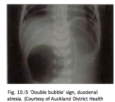 Polyhydramnios, distension of the stomach and blind loop of duodenum (double bubble sign)
Bilious vomiting