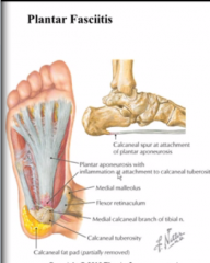 plantar fascitis because this whole aponeurosis is attached to the calcaneus