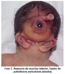 -holoprosencephaly is failure of left and right hemispheres to separate

-usually occurs in weeks 5-6

-complex multi-factorial etiology  possibly related to mutations in sonic hedgehog signaling pathway

-moderate for has cleft lip/palate
...