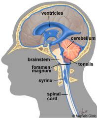 -Syrinx = tube (syringe)

-most common at C8 to T1

-syringomyelia associated with Chiari I malformation
--over 3-5 mm cerebellar tonsillar ectopia
--congenital, usually asymptomatic in childhood, then manifests with headaches and cerebellar...