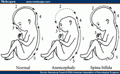 -if neuropores fail to fuse (fourth week), there will be persistent connection between amniotic cavity and spinal canal

-associated with LOW FOLIC ACID intake – before conception and during pregnancy

-elevated alpha-fetoprotein (AFP) in am...