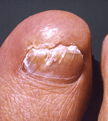 Karoline, 27 år fra Hestehave
- Udelukkende affektion af venstre fods førstetå
- Ingen andre symptomer
- Er professionel fodmodel