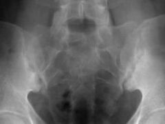 32yo M c/o low back & hip pain-> gradually worsening x 1 yr. sx are worse in the AM. xrays Fig A. Lab studies (+) HLA-B27. What additional finding confirm the dx? 1-Erythema marginatum; 2-(+) HLA-DR3; 3-Uveitis; 4-(+) Rheumatoid Factor; 5-Elevated...