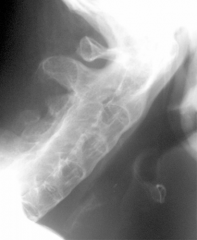 69yo M s/p fall on ice. On arrival in ER he is found to a 2 cm lac on the back of his head, c/o neck pain, but is oriented to place & time & neurologic exam = nl. Cervical & lumbar xrays no evidence of fx. What is the next step in tx.