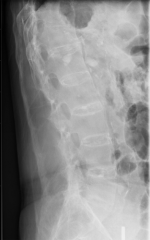 1-flex-ext xrays; 2-CT lumbar spine; 3-CT cervical spine; 4-technetium bone scan 5-treat w/ soft collar & d/c pt home::: increased risk for cervical fx->very difficult to see on xray->high mortality rate secondary to epidural hemorrhage->cervical ...