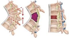 1-Smith-Petersen osteotomies; 2-Pedicle subtraction osteotomy (PSO); 3-Vertebral column resection (VCR); 4-Single-level opening wedge osteotomy; 5-Multi-level opening wedge osteotomies::: (PSO) provides > sagittal correction than: single-level ope...