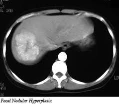 1. benign liver tumor without malignant potential that occurs in women of reproductive age. No association with OCPs!!
2. Usually asymptomatic although hepatomegaly may be present. 
3. Treatment not necessary in most cases