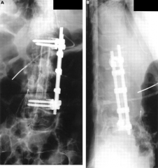 1-Intrathecal catheter placement w/ ABX x 6 wks 
2-I & D, corpectomy, fusion; 3- PO prednisone regimen x 4 wks; 4-I & D via posterior approach;5-Initiation of multiagent abx regimen for TB x 6 mths:::extensive destruction of the lumbar spine exte...