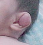 DTDST gene, sulfate transporter important in cartilage conversion to bone

cauliflower ear, diastrophic dwarfism, clubfoot, hitchhiker thumbs +/- cleft palate