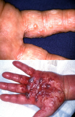 Uffe, 60 år fra Strib
- Intenst kløende
- Håndflader, samt fingres bøje- og lateralsider

