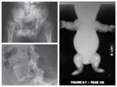 Most common form of dwarfism 


 


Results from diminished proliferation of cartilage in growth plate - bones can't grown in length b/c of missing cartilage


 


Characterized by short limbs & normal trunk 


 


Posterior scallop...