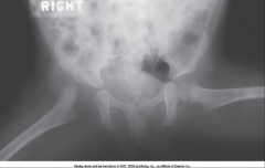 Incomplete formation of acetabulum 


 


More common in Females


 


Hip may "pop" out of joint & a "click" may be felt/heard during exam with flexion & abduction 


 


Treatment: Pelvic cast or immobilization of femoral head - m...