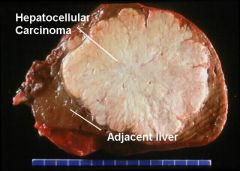 1. HCC - 80% of primary liver cancers-- common in Africa and Asia although rare in U.S.
2. Nonfibrolamellar (most common) - assoc with Hep B, C amd cirrhosis- usually unresectable and with a very short survival time (months)
- fibrolamellar- usu...