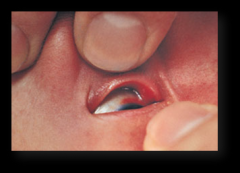 Breakage of small blood vessels in the eyes of a newborn.

One or both eyes may have a bright band around the iris.

Causes: traumatic delivery, spontaneous, occasionally results from severe sneezing or coughing.  Rarely due to blood dyscrasia...