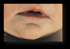 Very common, benign, keratin-filled cysts that appear as superficial  pearly white to yellow domed papules measuring 1-2 mm in diameter.

Usually on the face, especially the nose.
Spontaneously disappear within the first few weeks of life.