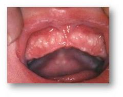 Milia that are located intraoral.

Small, pearly nodules along the midline of the hard palate and are benign retention cysts.