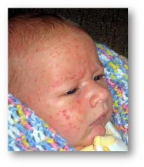 Baby acne
Inflammatory papules or pustules, absence of comedomes.
Generally limited to the face.
Onset at 3 weeks and generally resolves around 4 months.
No treatment necessary but may use soap and water, 1% hydrocortisone or 2% ketoconazole.
...