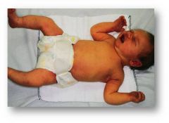 Physiologic jaundice is visible jaundice appearing after 24 hours of age.
If jaundice apparent before 24 hours it is pathologic in origin!
Total bilirubin increases by <5 mg/dL per day.
Peak bilirubin occurs at 3–5 days of age, with a total b...