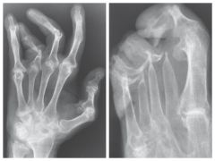 Destructive Process of peripheral joints that develops in pts with psoriasis


 


Involves distal IP joints of hands and feet


 


 