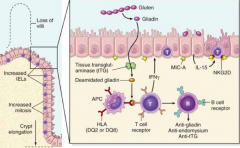 - Gluten comes in and is degraded by your enzymes into Gliadin 
- Gliadin enters tissue and tissue transglutaminase (tTG) converts it to deamidated gliadin
- Deamidated gliadin is presented to APC
- Stimulates T cells, which release IFN-gamma 
...