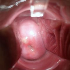 what is on the cervix?


what is it caused by?