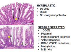 Hyperplastic Serrated Polyp
- 60-90% of serrated polyps
- Distal colon
- No malignant potential
