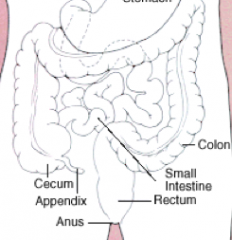 - Rectosigmoid colon (55%)
- Cecum and ascending colon (22%)
- Transverse colon (11%)
- Descending colon (6%)