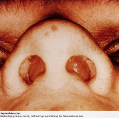 - Ohne Zerreißung der Nasenschleimhaut bildet sich ein Hämatom zwischen Knorpel und Knorpelhaut (Perichondrium) bzw. zwischen Knochen und Knochenhaut
- Völlige Verlegung des Nasenlumens mit (doppelseitiger) Behinderung der Nasenatmung kurz nach...