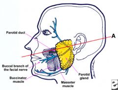 A: Vertical lacerations anterior to posterior border of masseter muscle likely to injure the parotid duct 

A: The duct exits the parotid abutting masseter then runs in a line drawn between tragus and the midportion of the upper lip, coursing alon...