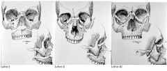 A: LeFort I- Palate-face dysjunction, lower face & maxillae move separately- involves nasal septum, laterally & posteriorly through all maxillary walls to pterygoid platesA: LeFort II- Pyramidal dysjunction, maxillary & nasal regions move separate...