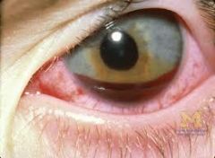 A: Hyphema (see pic) 

A: Globe rupture 

A: Significant edema (e.g. post orbital hematoma drainage) 

A: Only seeing eye