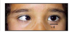 Why would someone have a medial/internal strabismus?