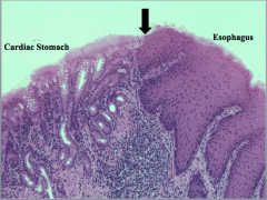 Junction of esophagus and stomach