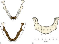 A: Jewer HCL classification: H= hemimandible (L+condyle), L= lateral mandible excluding condyle, C= central segment (incisors and canines)B: Urken’s classification: Condyle (C), Ramus (R), Body (B), Symphysis (S, SH for hemisymphysis)