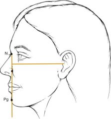 A: In the facial profile view, it is perpendicular from the Frankfort line, passing through the Nasion 

A: Midforehead, Subnasale, upper/lower Lips, Pogonion all lie on the line