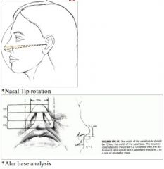 A: Nasal Width from alar groove to alar groove = 70% the Length of the nose from nasion to tip defining point; nasal width equal to intercanthal distanceA: Nasion at level of upper eyelidA: Four profile measuresContour – should be relatively str...