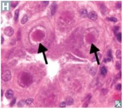 -Characteristic Cowdry Type A intranuclear inclusions (Herpesvirus) 
-"Owl eye" appearance of cells