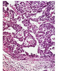 Malignant tumor with painful, palpable mass in the scrotum and eleveated hCG
 
Histology is more glandular 