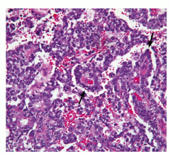 Most common testicular cancer in children < 3
Elevated AFP, with schiller-duval bodies in testes (look like glomeruli)