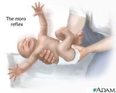 5 months
Head drops into extension suddenly -> arms abduct, fingers open, then cross into adduction; cry