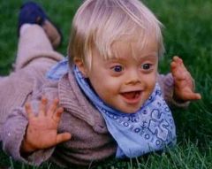 Trisomy 21 (genetic abnormality)
Risk increased with advanced maternal age
Mental retardation, hypotonia, joint hypermobility, etc
