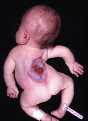 Developmental abnormality due to insufficient closure of neural tube by 28th day of gestation.
Affects CNS, musculoskeletal, and urinary systems
Spina Bifida Occulta - fusion of spinous process.  Spinal cord and meninges remain in tact
Spina Bi...