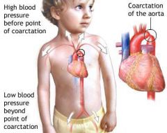 Congenital heart defect in which the aorta is narrowed near the ductus arteriosus.
Ranges from mild to severe and may not be detected until adulthood.
s/s include SOB during exercise, intermittent claudication weakness, headache.  High blood pre...