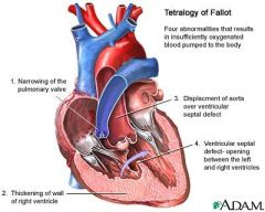 1) VSD
2) pulmonary stenosis
3) right ventricular hypertrophy
4) aorta overriding the ventricular septal defect
Death or disability common by early adulthood.  Tx - surgery to patch VSD and widen the pulmonary valve and arteries